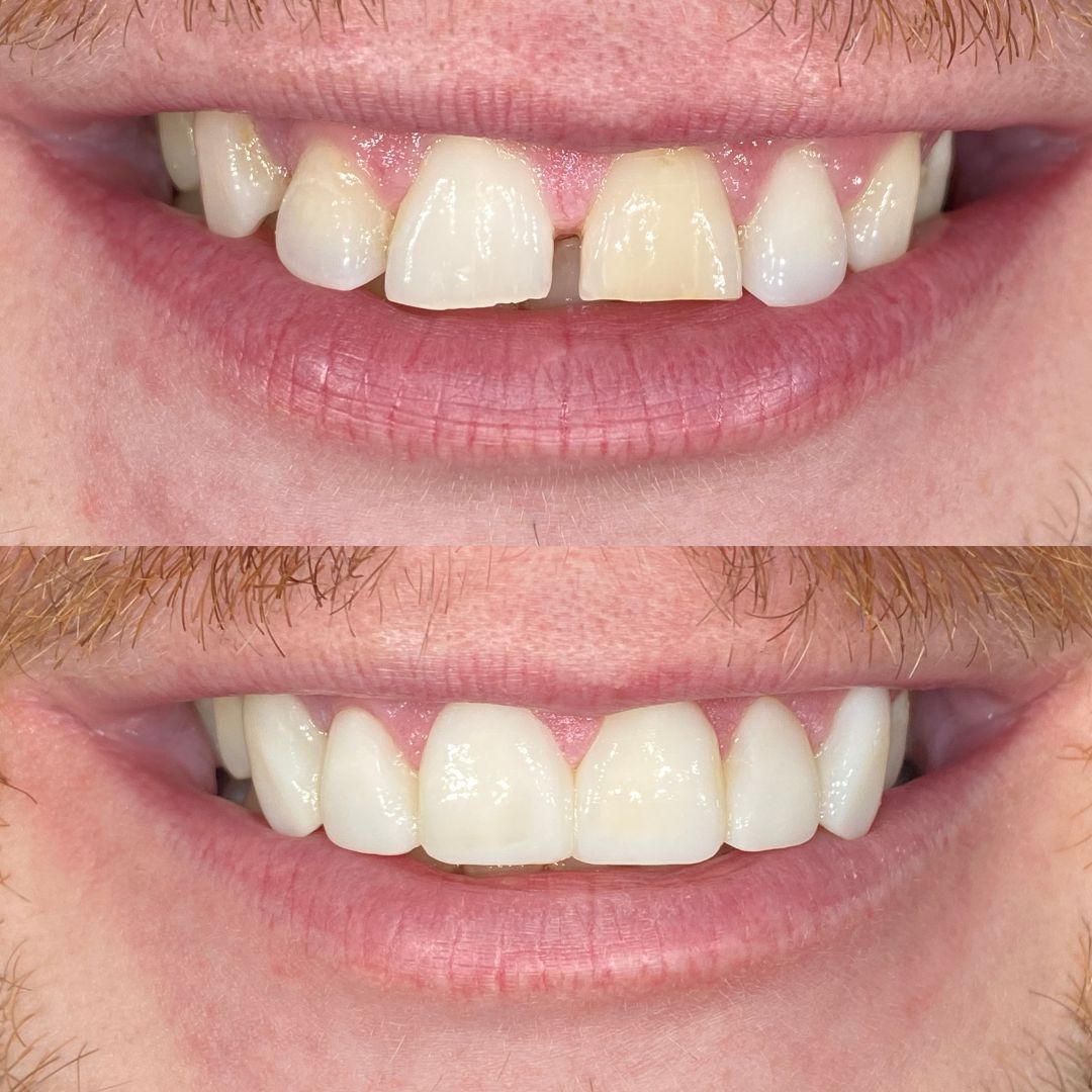 How Much Is Composite Bonding Coatbridge Family Dental Care How Much Is Composite Bonding Coatbridge Family Dental Care